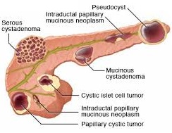 Pancreatic lesions